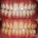 歯を白く!!ホワイトニング♪