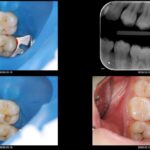 たった1回で治療終了ダイレクトボンディング治療
