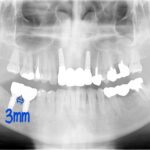 インプラント手術で方向がズレると・・・