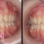 前歯だけのマウスピース部分矯正