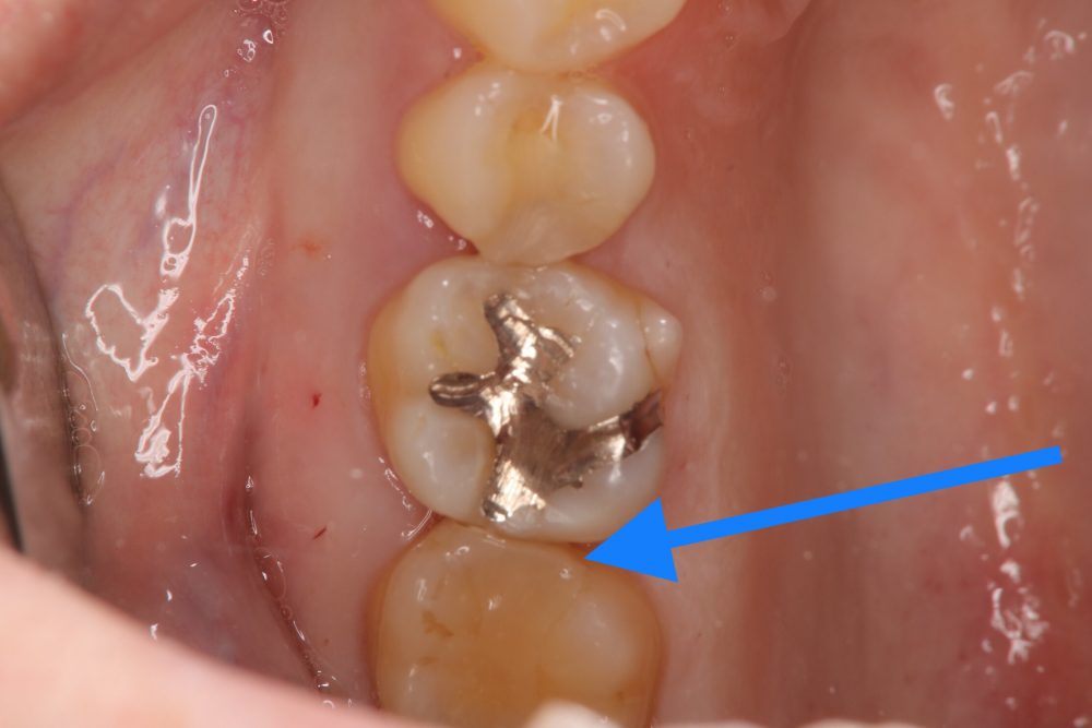 虫歯の箇所