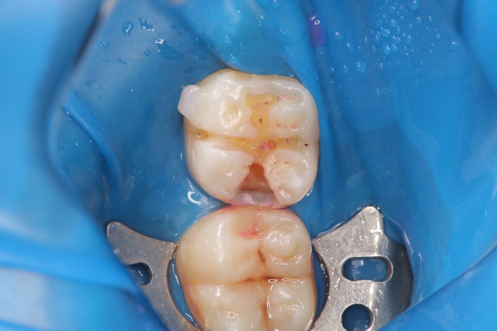 歯の切除