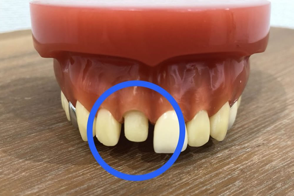 クラウンの治療が可能な歯