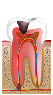 重症化した虫歯