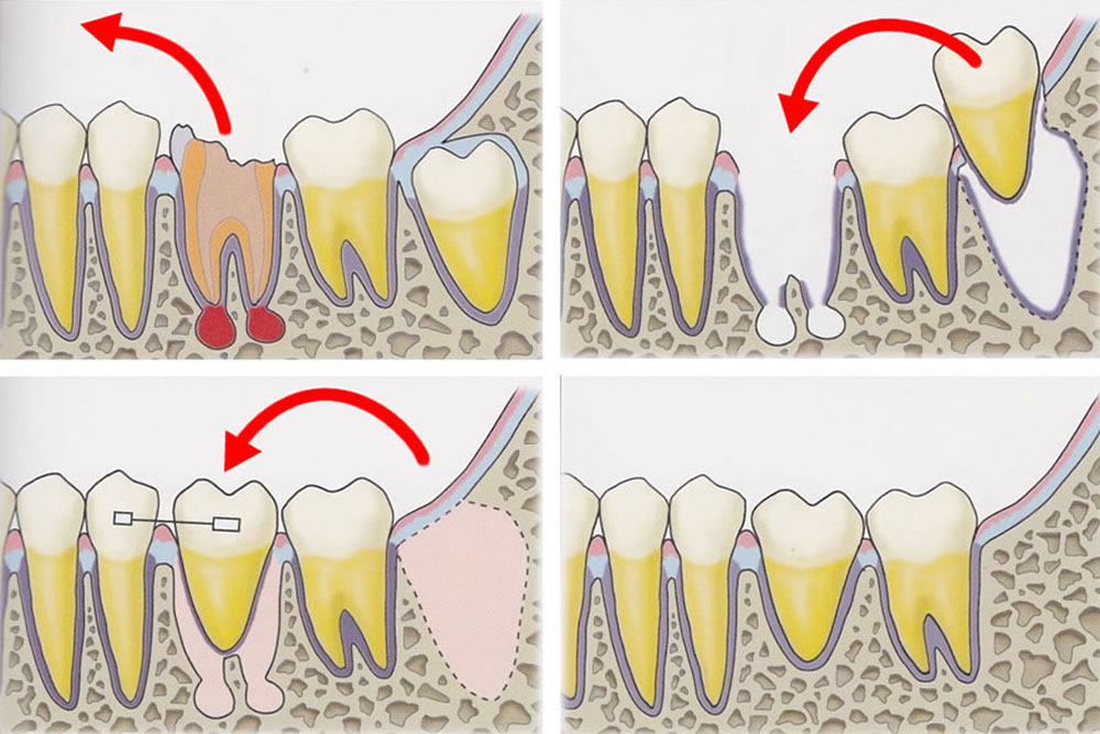 自牙歯牙移植による咬みあわせの回復