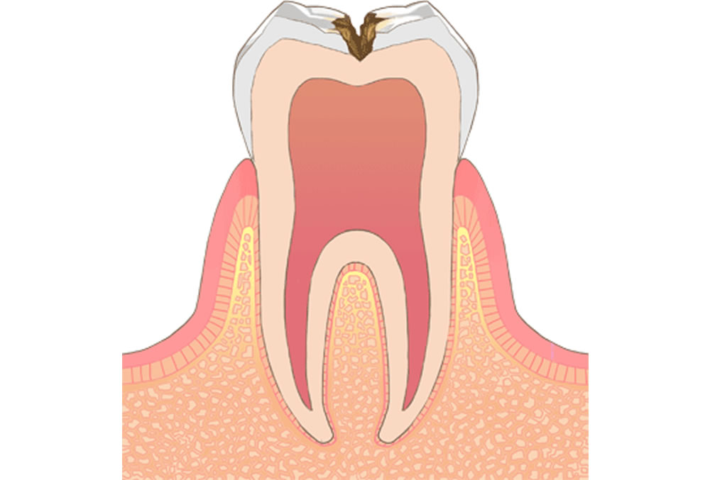 虫歯・歯周病予防の習慣化