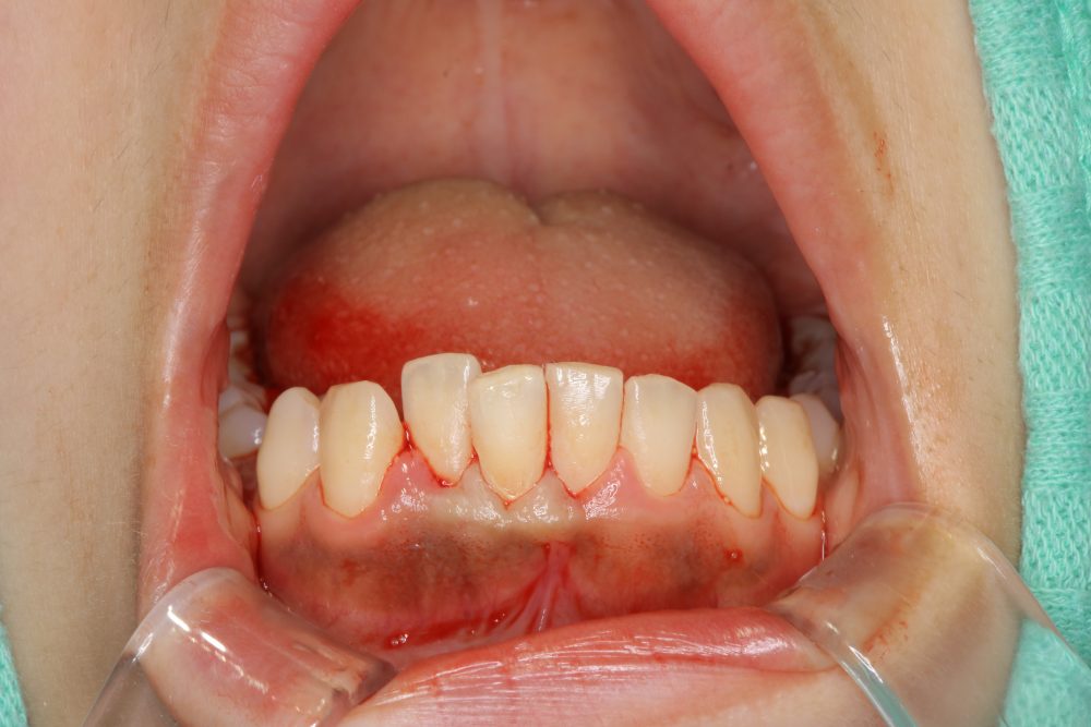 歯茎の治療