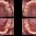 インビザラインで抜歯はできる！？