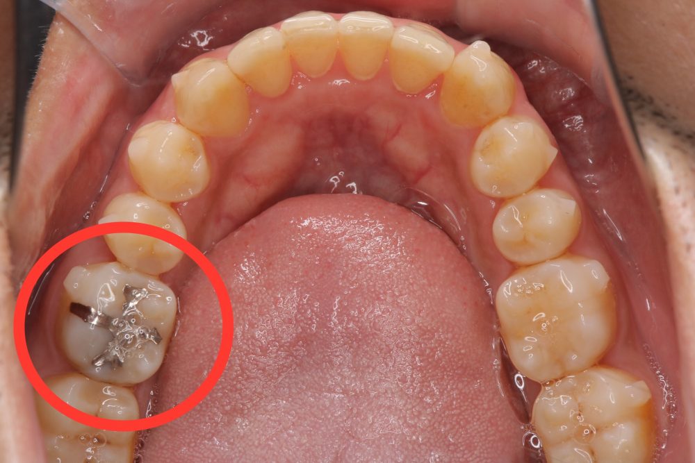 矯正治療中でも虫歯治療はできますか？