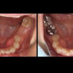 インプラント手術は6分で終わります！