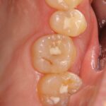 歯の神経を絶対残したい！