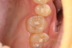 歯の神経を絶対残したい！