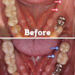 入れ歯をインプラントで、再び噛めるように！