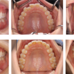 内側に重なった前歯のインビザライン矯正例