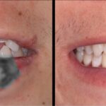 事故で折れた前歯を「セラミック」で治しました