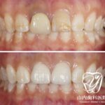 昔に治療した前歯が「変色」した場合の審美治療