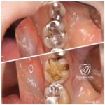 「神経を取らないと、、」と診断された場合でも諦めないで下さい！