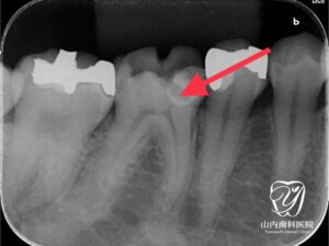 MTAを使った神経の保護