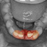 交通事故で歯が抜けた！どうする！？