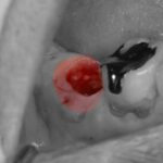 重度歯周病から自分の歯を救う”歯の再植”