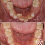 子供の矯正は早めが大事です！