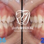 内側に重なった前歯”半年間マウスピース矯正”