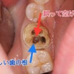 誤って歯に空けた穴を塞ぐ治療
