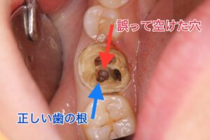 誤って歯に空けた穴を塞ぐ治療