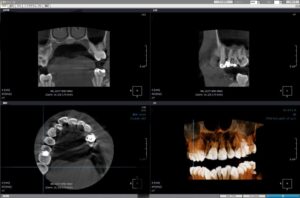 定期健診で発見されなかった虫歯