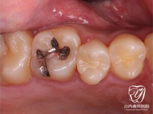 セラミック治療1