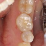 銀歯の下の虫歯をセラミックインレーで治療