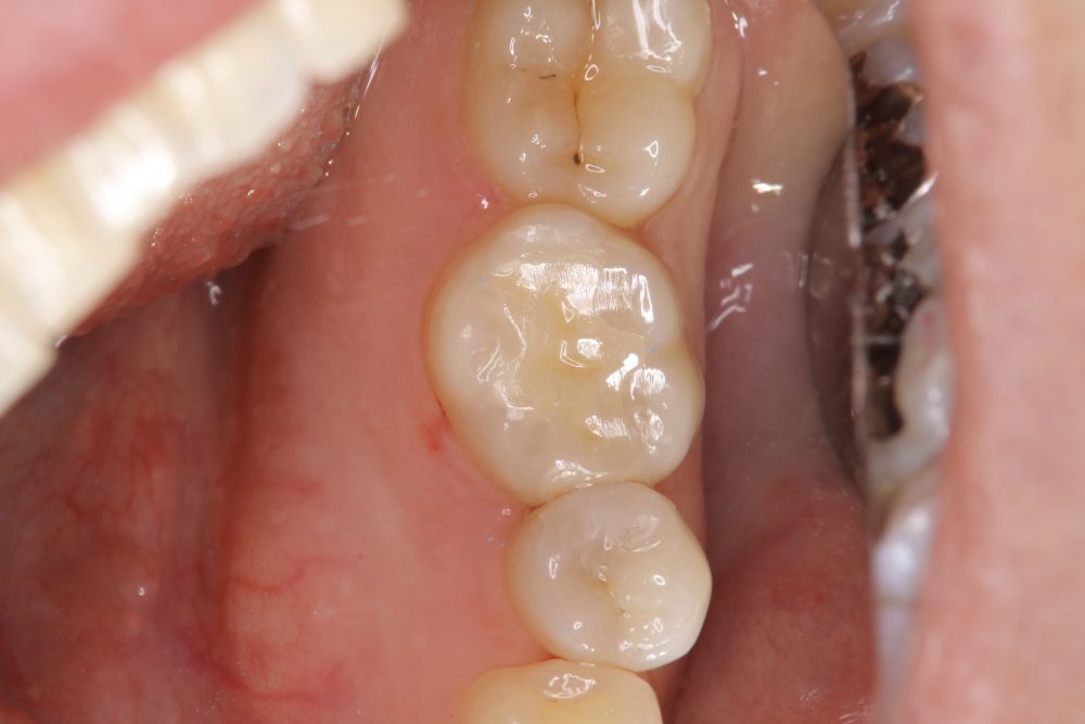 銀歯の下の虫歯をセラミックインレーで治療