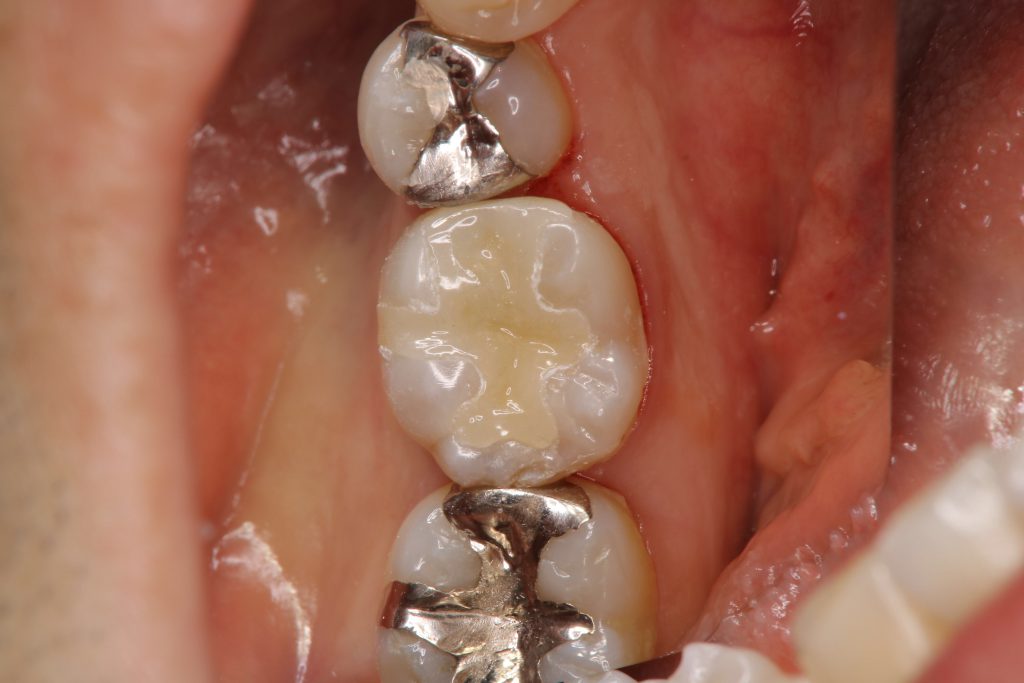 歯の神経を残す治療3