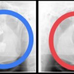 横向きの親知らずの抜歯