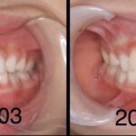 すきっ歯のこどもをマウスピース矯正