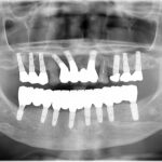 たった1日で総インプラント